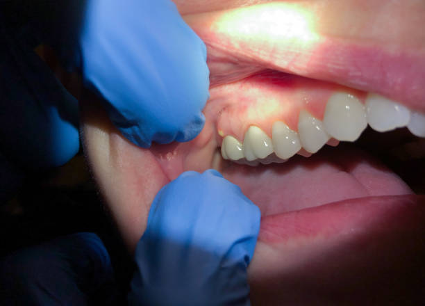 Best Dental Abscess Treatment in Marianna, FL